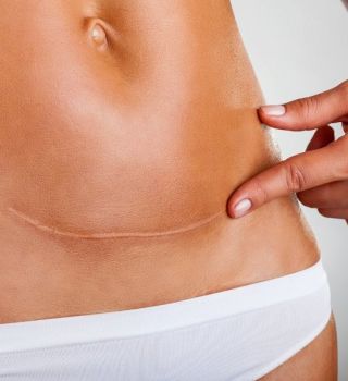 ScarWork Scar Tissue Massage